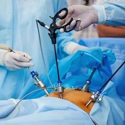 Can Laparoscopic Surgery Be Performed for Gynaecological Issues